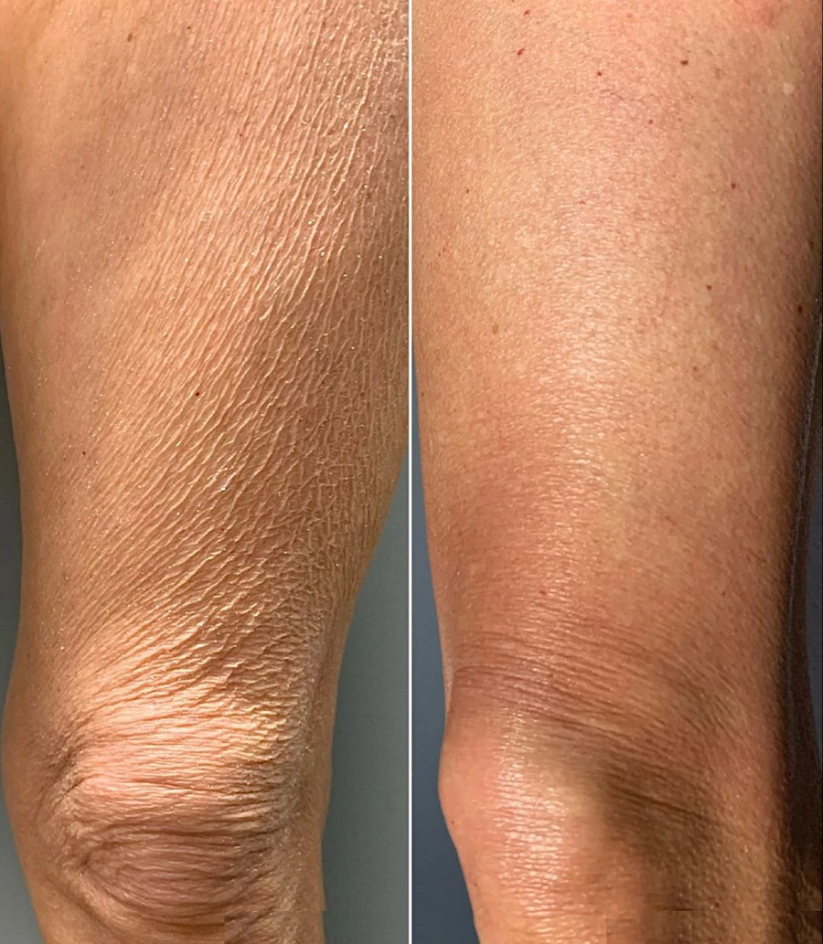 Genoux & haut des jambes